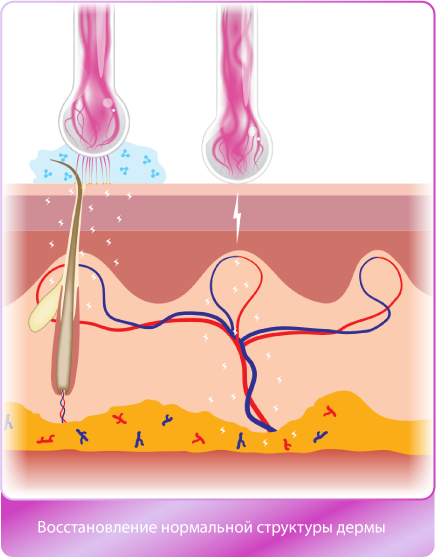 импульсный аппарат дарсонваль применение восстановление нормальной структуры дермы